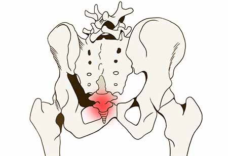 尾てい骨が痛い原因 強打からの骨折や打撲の症状に治療方法について コタローの日常喫茶
